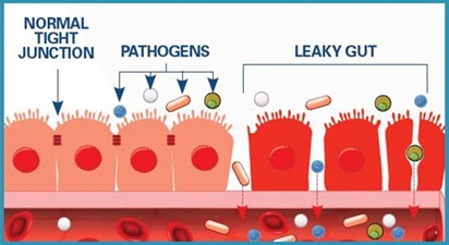 Áteresztő bél szindroma (leaky gut) okai, kezelése